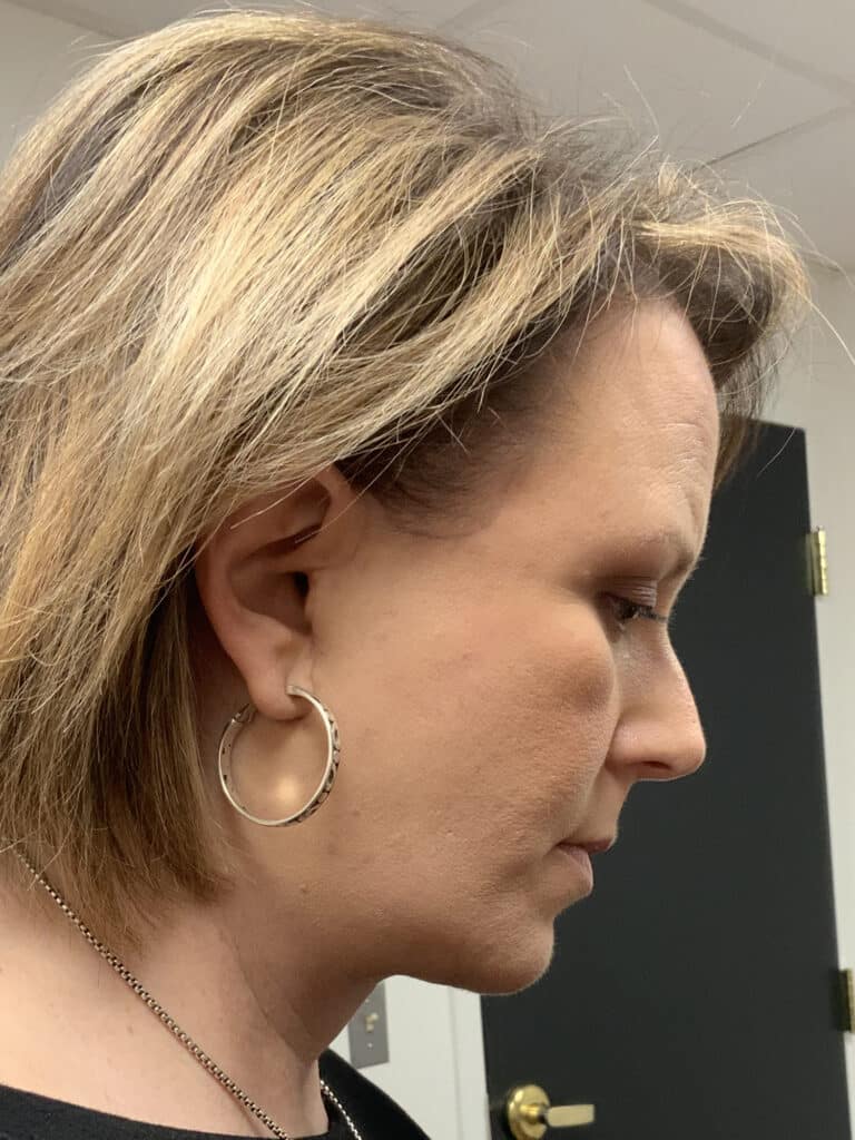 After Image: Facelift / Under Chin and Eyes - right-side