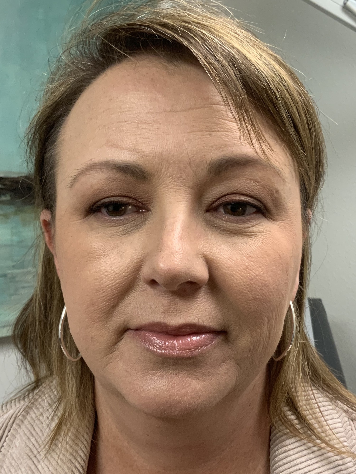 Before Image: Facelift / Under Chin and Eyes - front