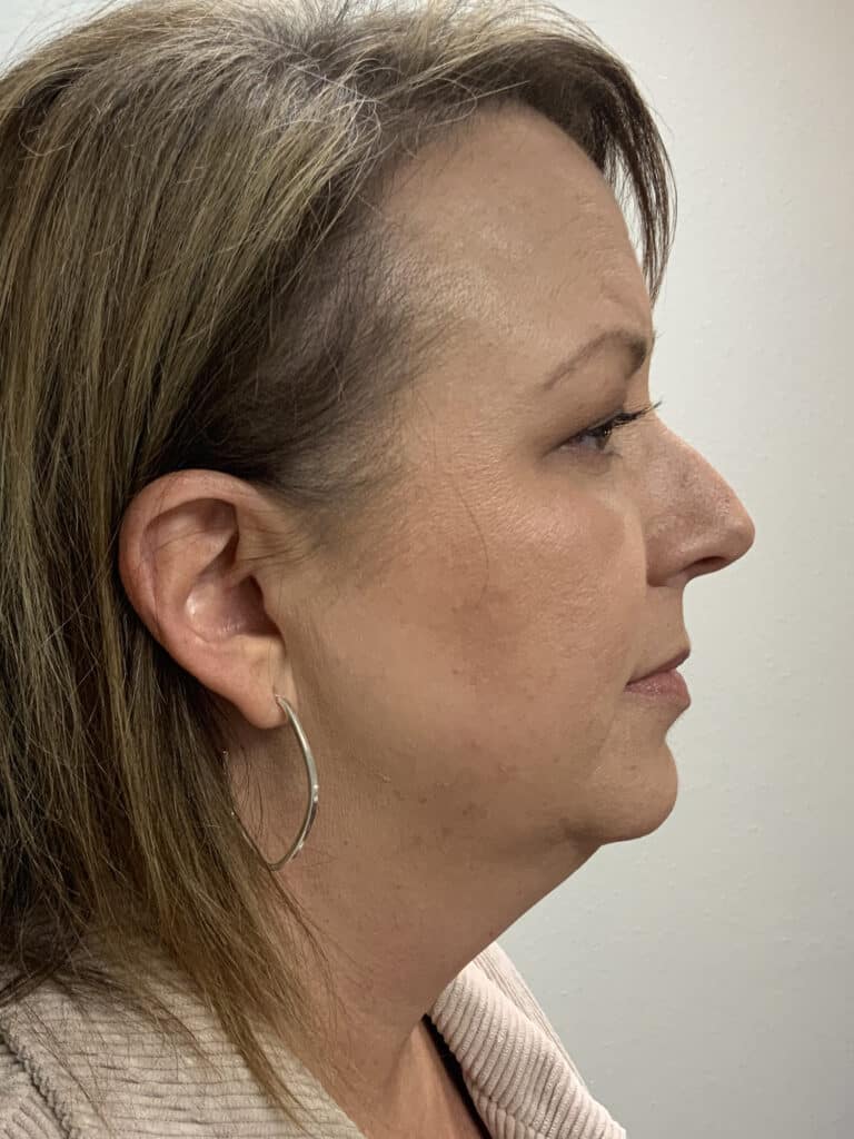 Before Image: Facelift / Under Chin and Eyes - right-side