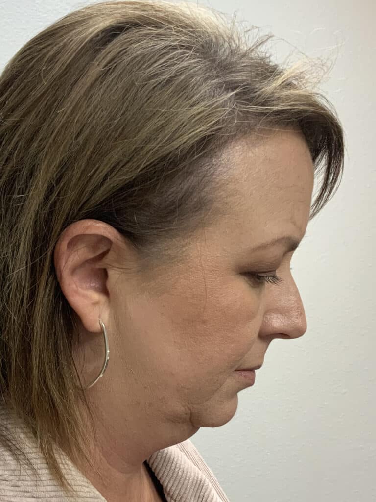 Before Image: Facelift / Under Chin and Eyes - right-side