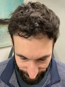 After Image: Hair Restoration