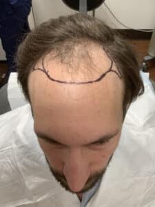 Before Image: Hair Restoration
