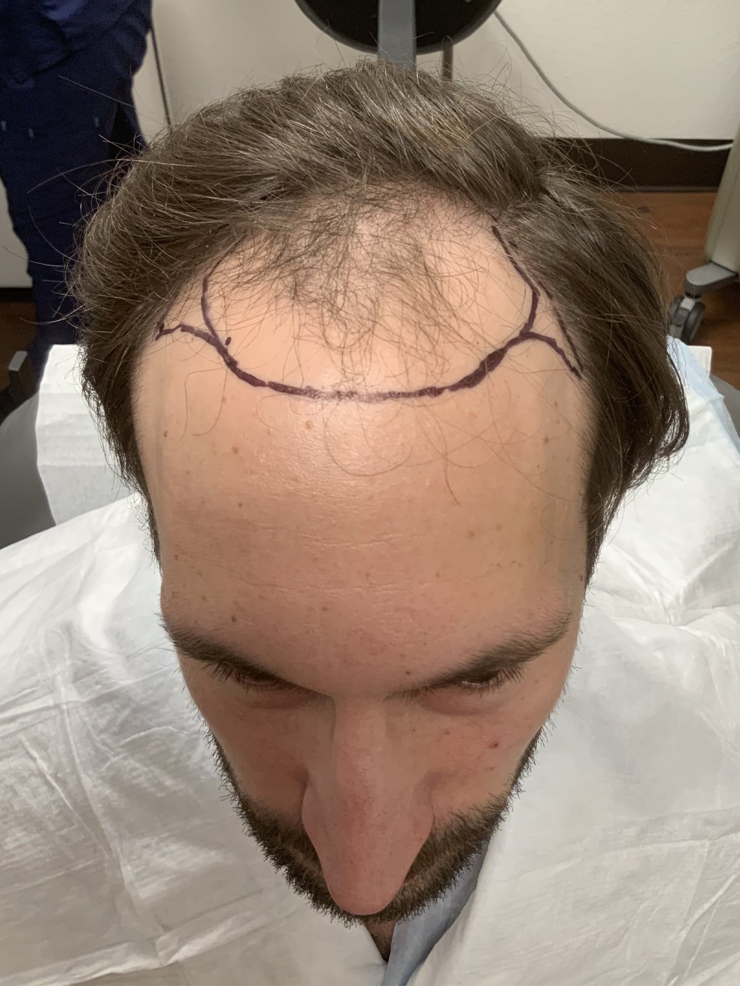 Before Image: Hair Restoration - front
