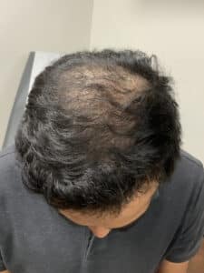 After Image: Hair Restoration