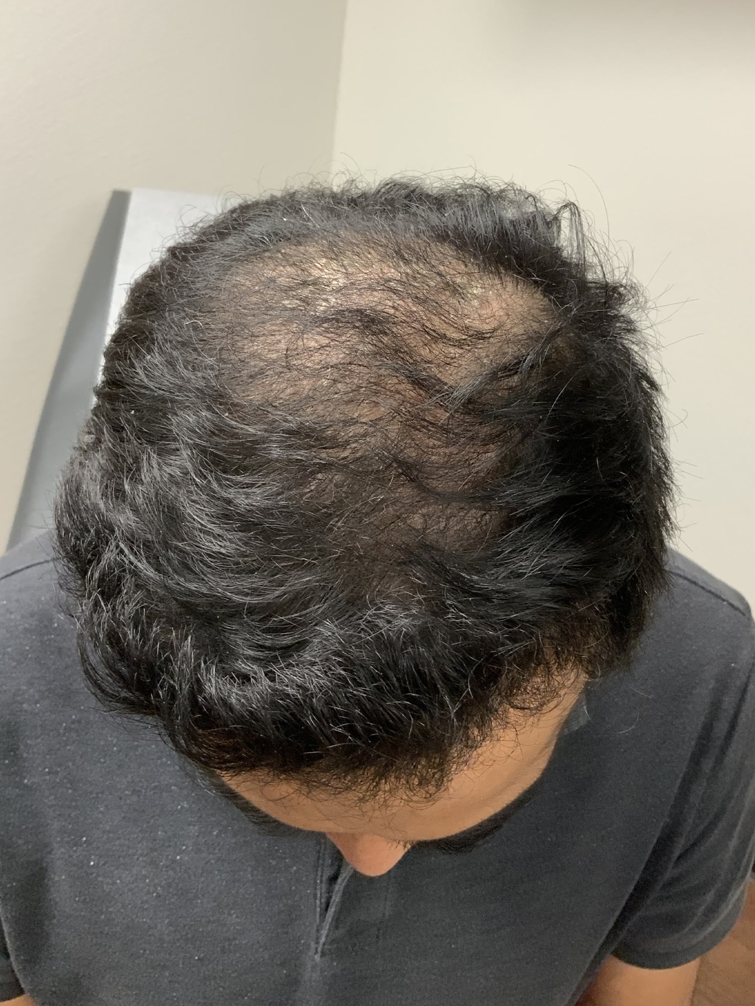 After Image: Hair Restoration - front