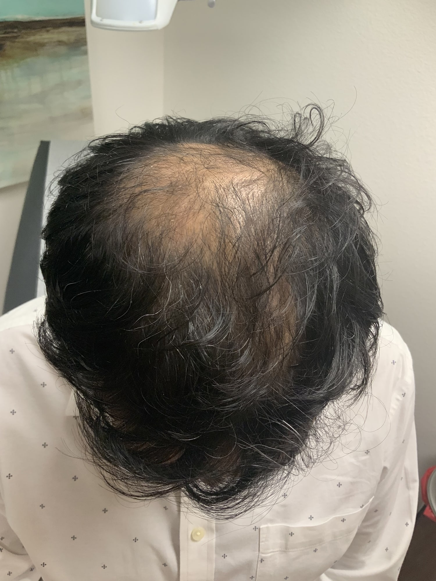 Before Image: Hair Restoration - front