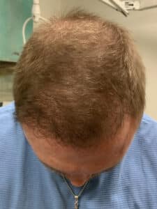 After Image: Hair Restoration