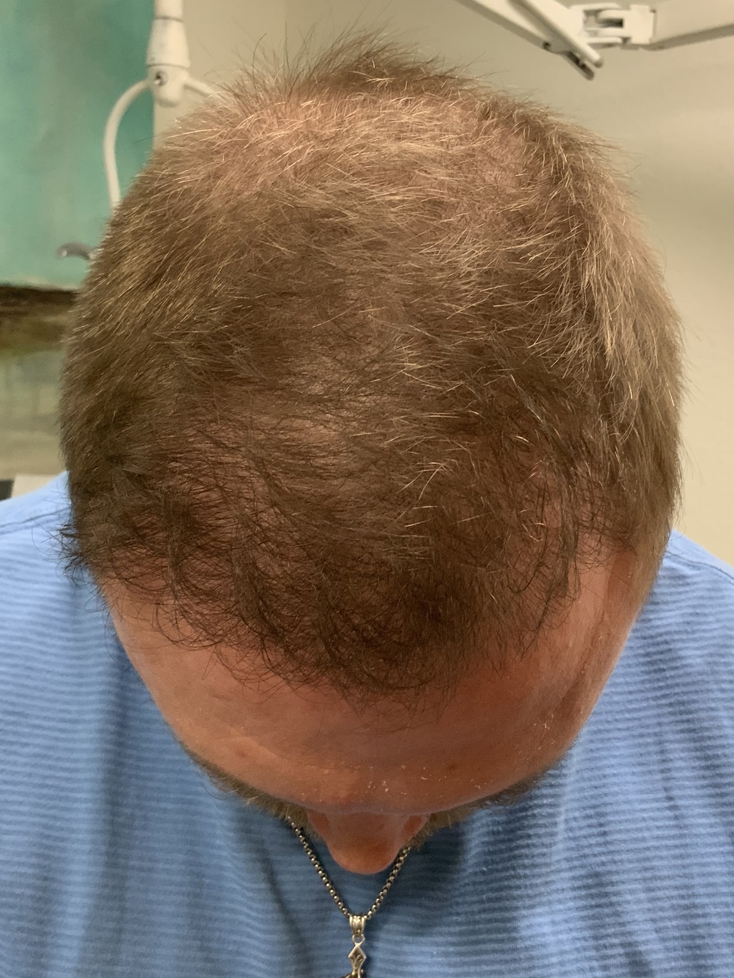 After Image: Hair Restoration - front