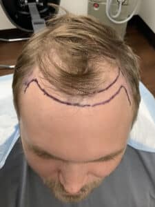 Before Image: Hair Restoration