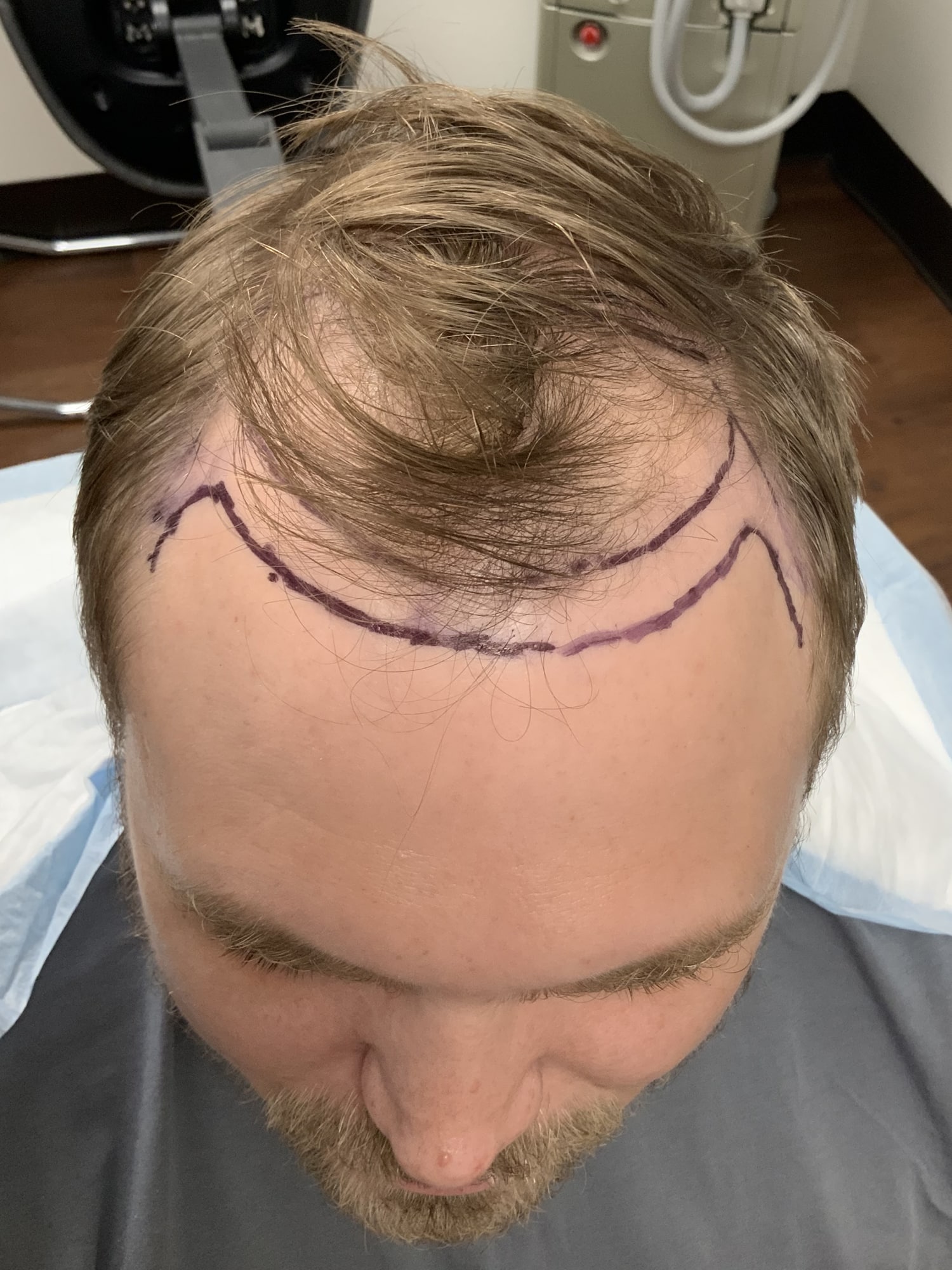 Before Image: Hair Restoration - front