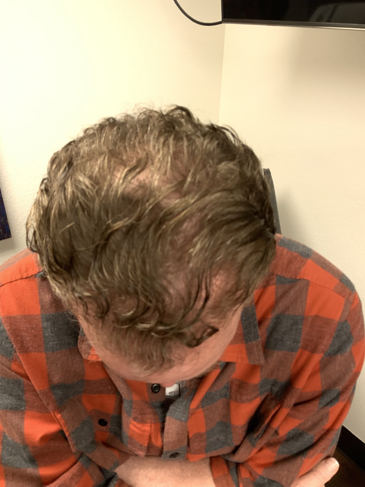 After Image: Hair Restoration - front