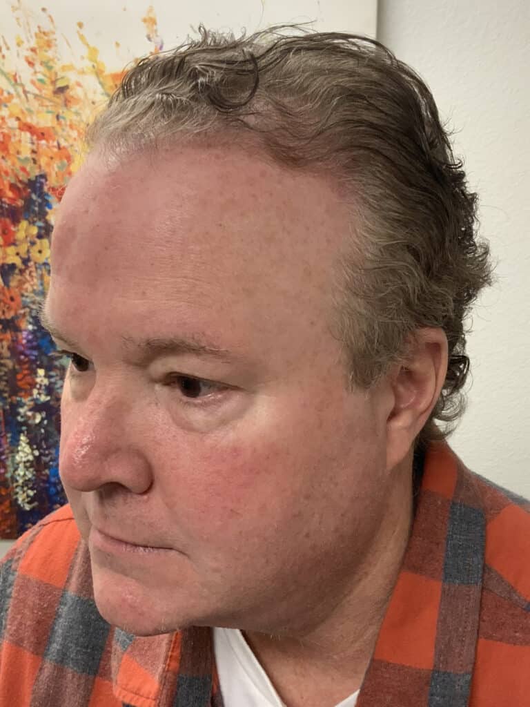 After Image: Hair Restoration - left-front-oblique