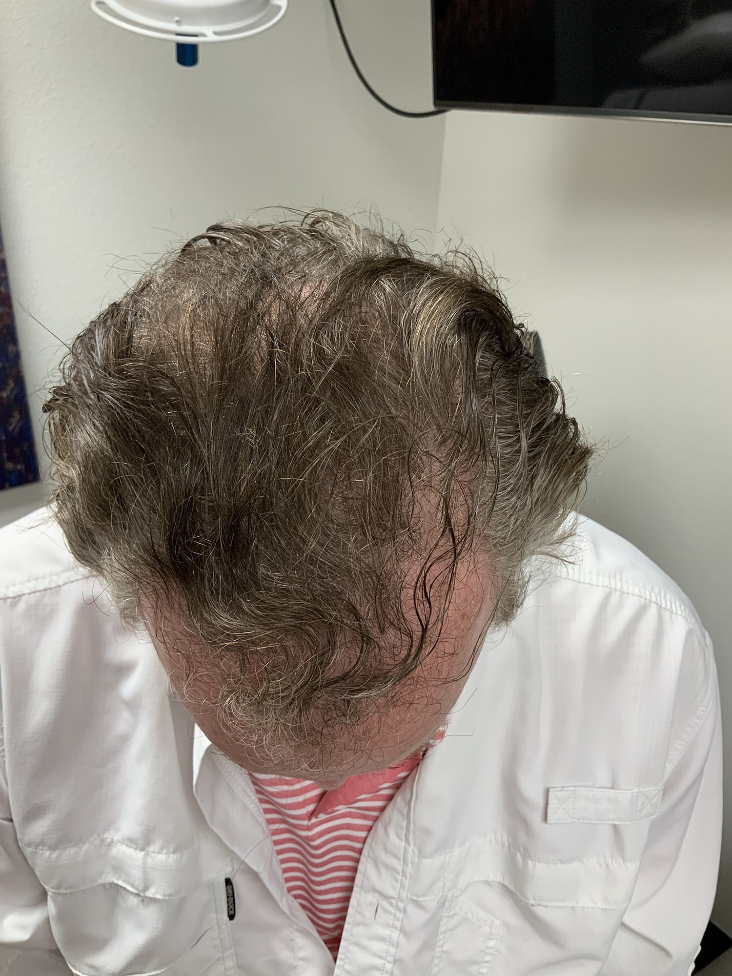 Before Image: Hair Restoration - front