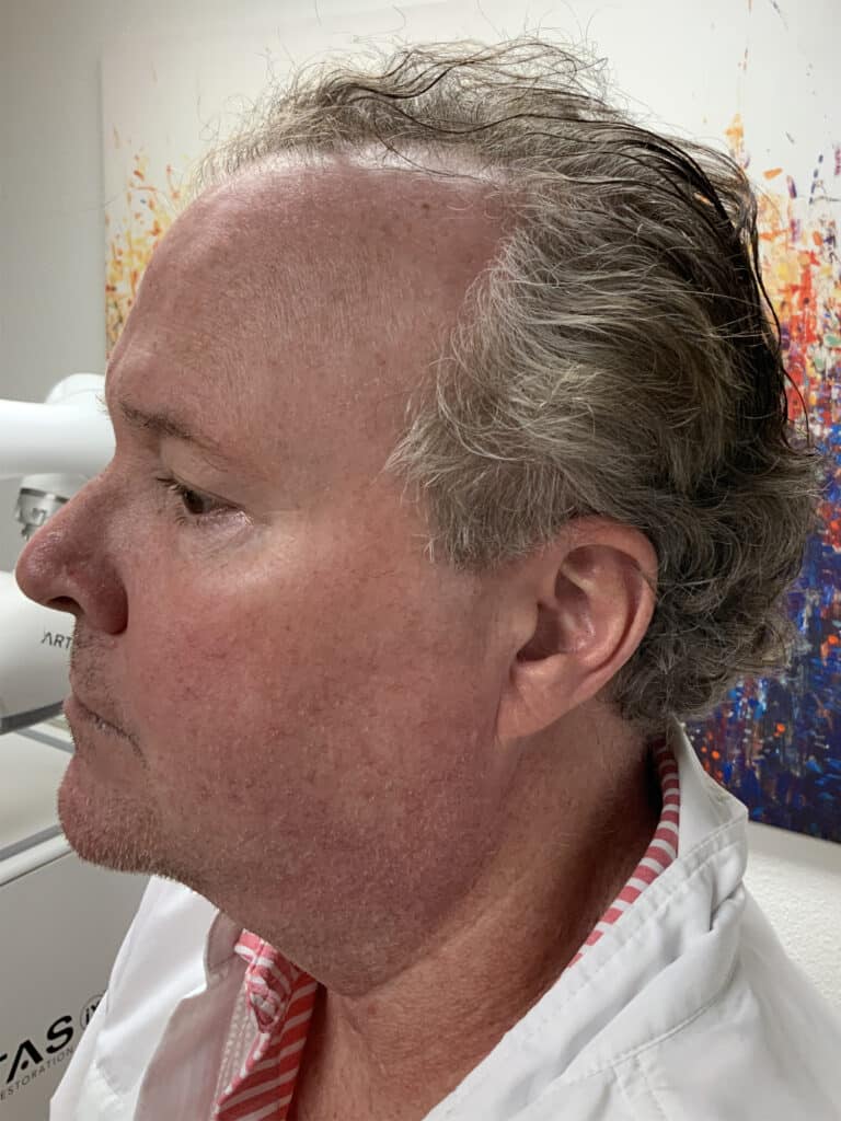 Before Image: Hair Restoration - left-front-oblique