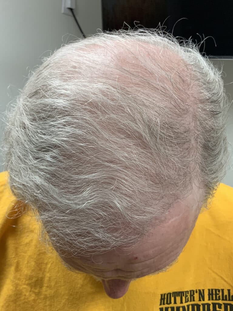After Image: Hair Restoration - front