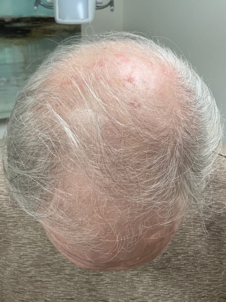 Before Image: Hair Restoration - front
