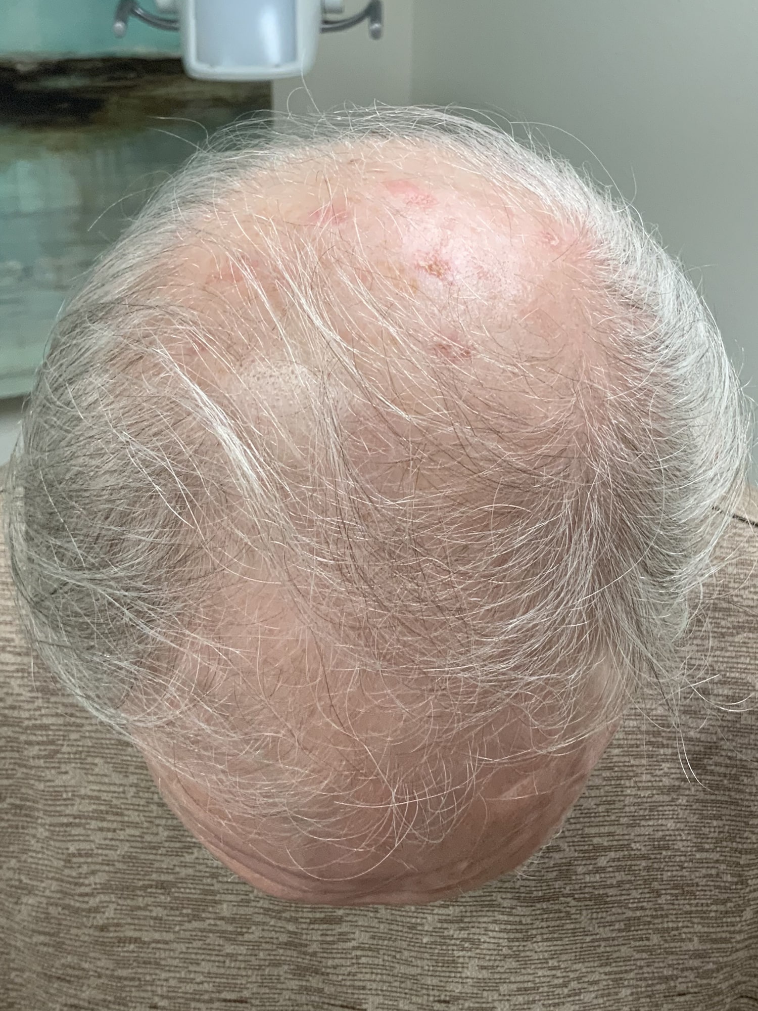 Before Image: Hair Restoration - front