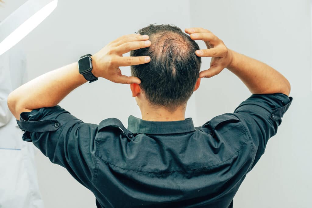 The back of a balding man's head before ARTAS® iX in Lewisville, TX