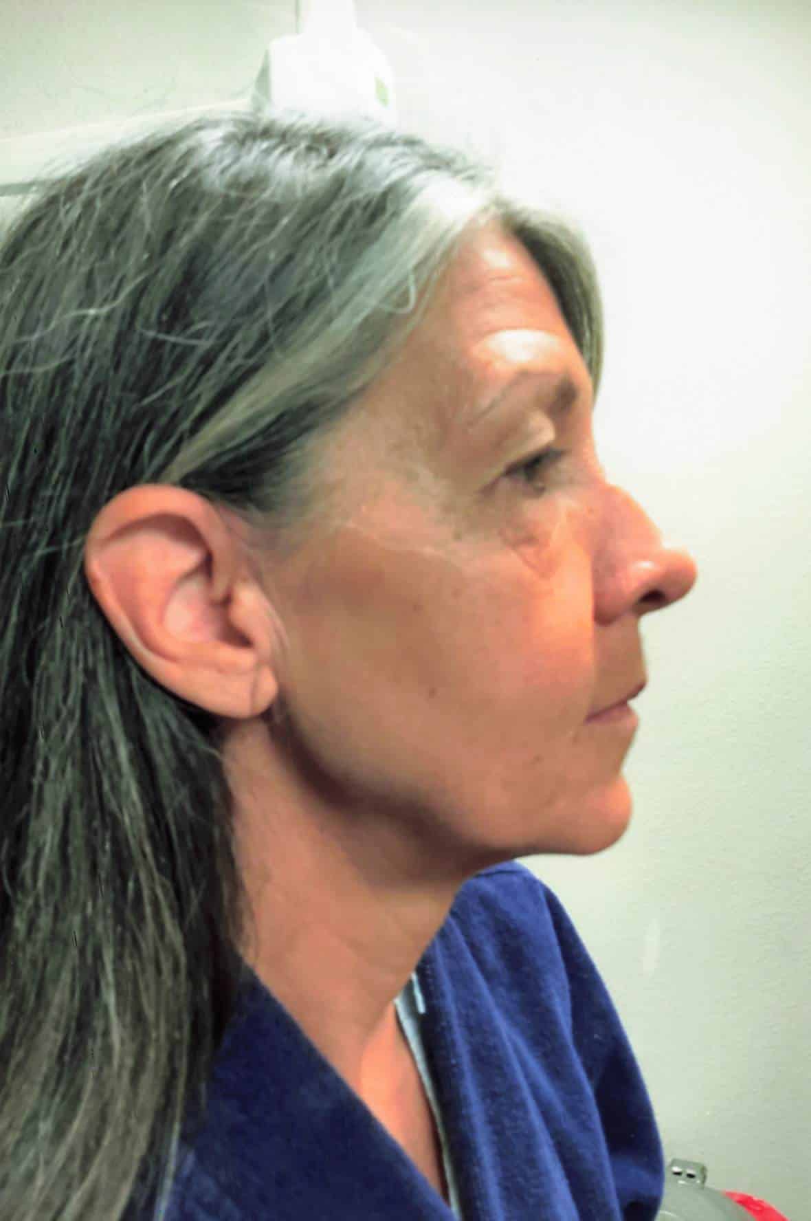 Before Facelift Lewisville TX