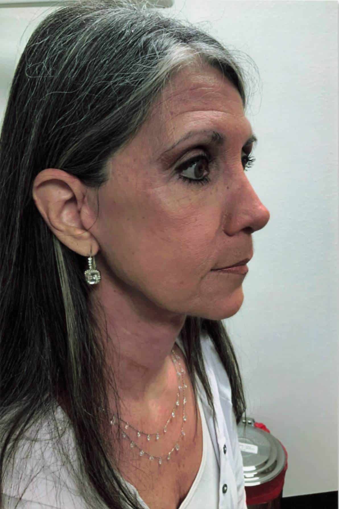 After Facelift Lewisville TX