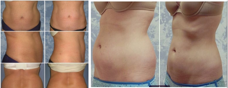 Before And After Liposuction Lewisville TX