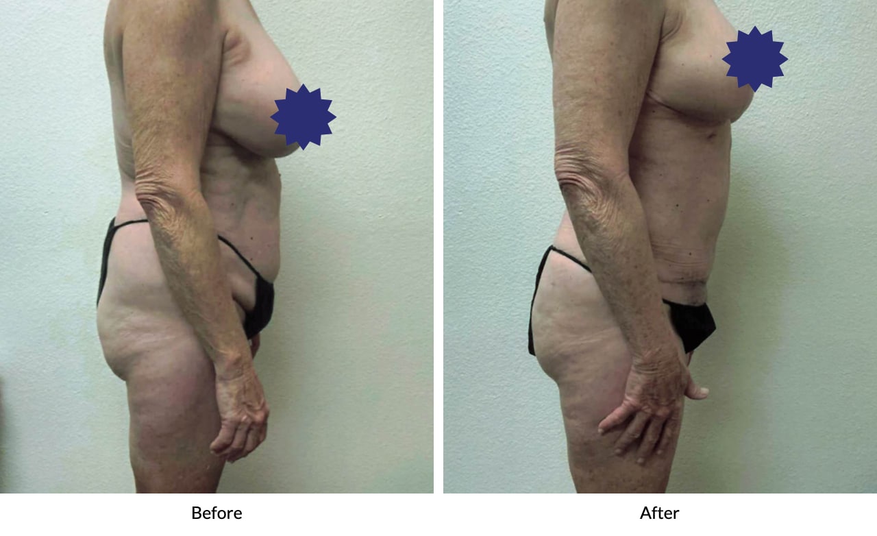 Before And After Mommy Makeover Lewisville TX