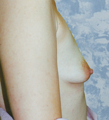 Before Image: Breast Augmentation Patient B. T. - other