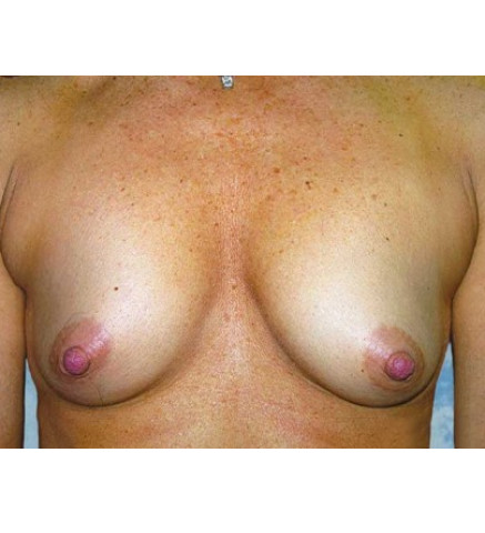Breast Augmentation Patient L. Y.