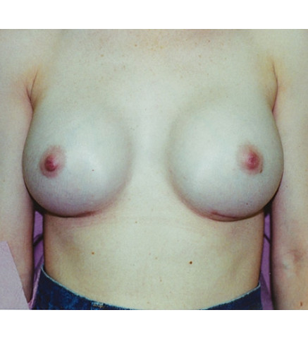 Breast Augmentation Patient V. E.: 2 Week Post Op