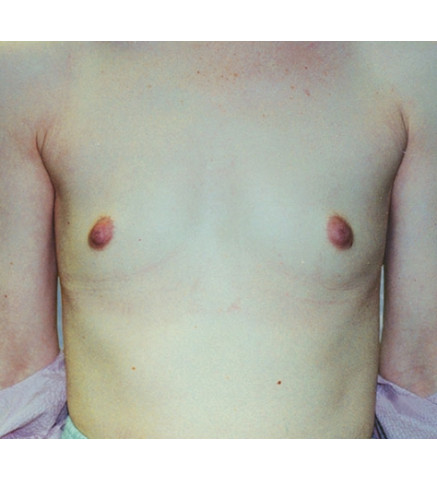 Breast Augmentation Patient V. E.: 2 Week Post Op