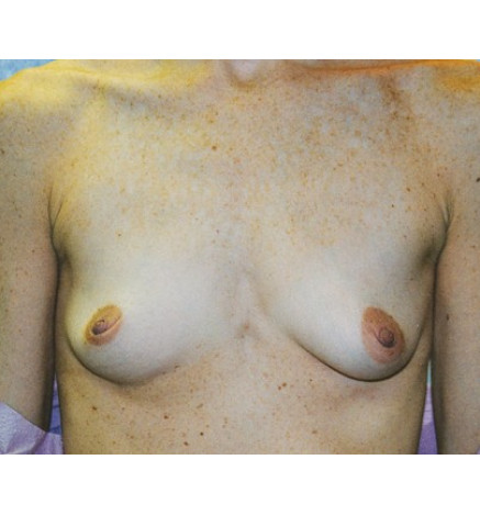 Breast Augmentation Patient S. T.