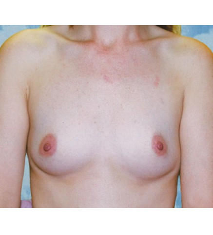 Breast Augmentation Patient R. O.