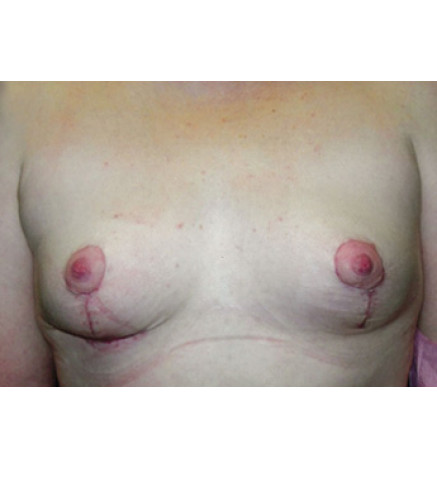 Complicated Breast Lift & Augmentation Patient: 1 Week D. B.