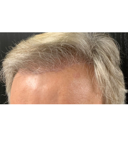 Hair Restoration