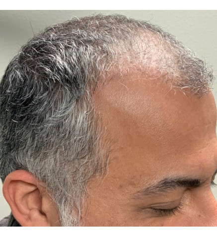 Hair Restoration