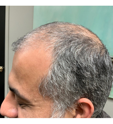 Hair Restoration