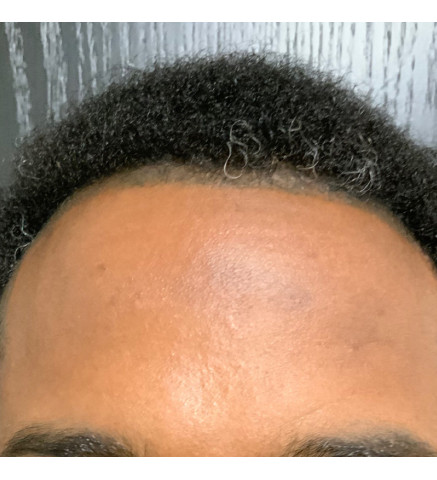 Hair Restoration