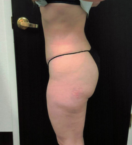 Liposuction