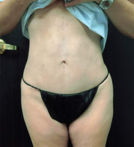 Tummy Tuck