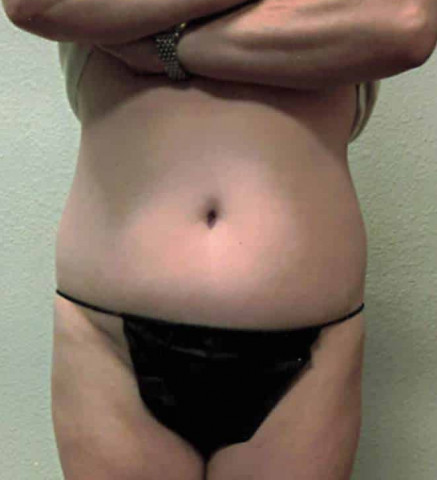 Tummy Tuck