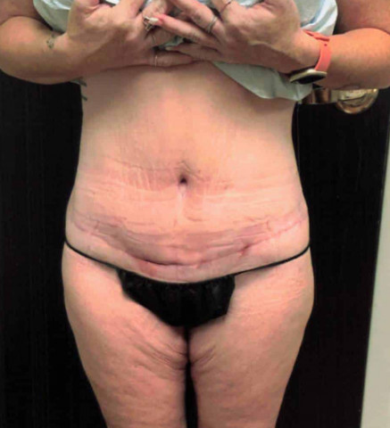 Tummy Tuck